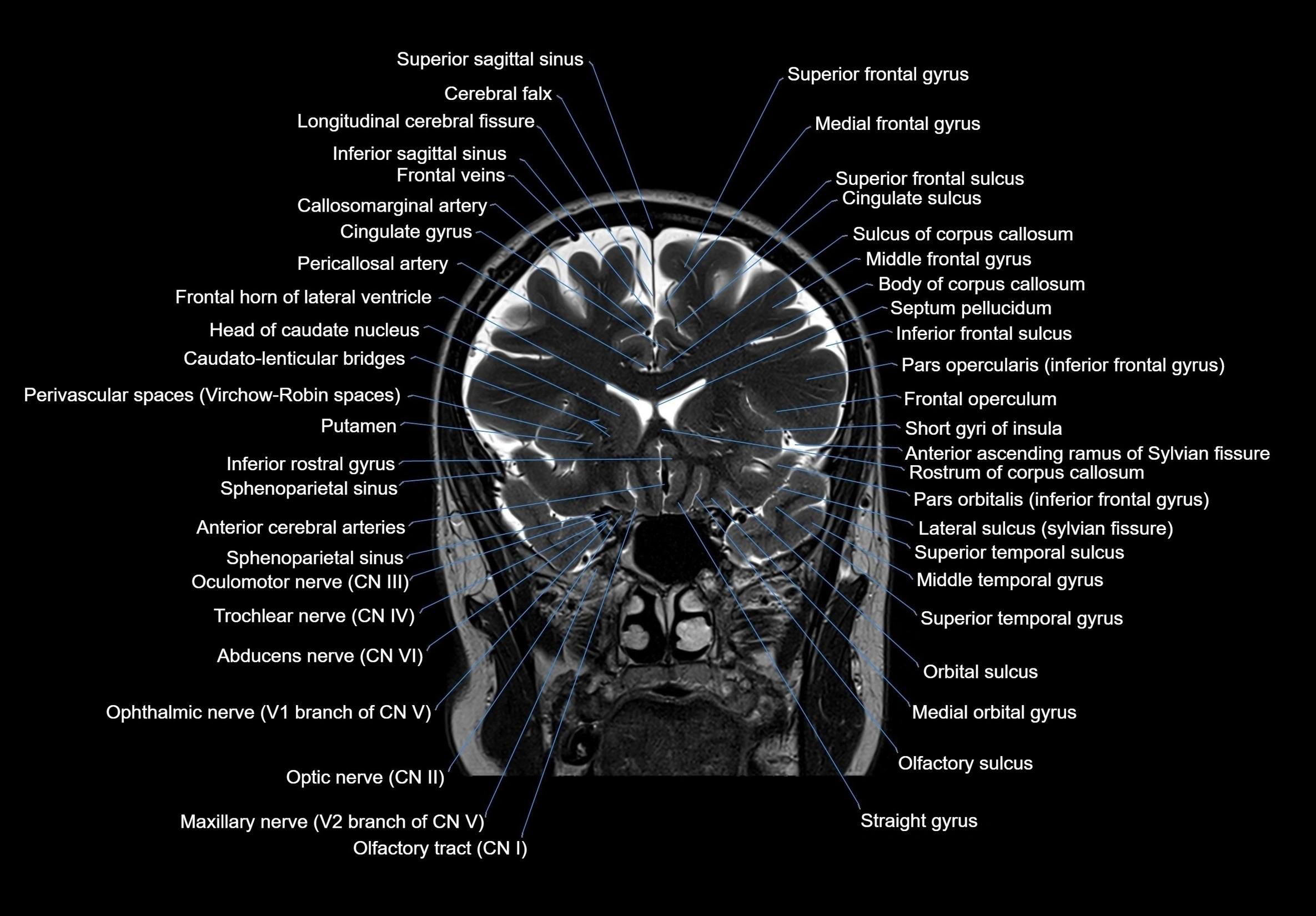MRI Brain coronal cross sectional labelled anatomy 3T image  -img-00001-00026.webp